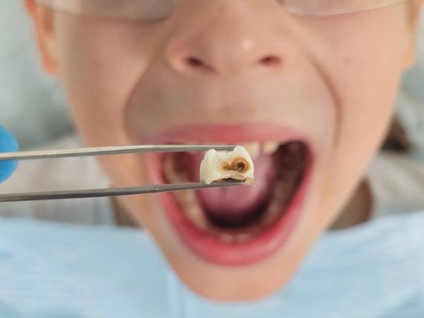 Best Emergency Treatment for Dental Infections or Abscesses in West Salem, WI